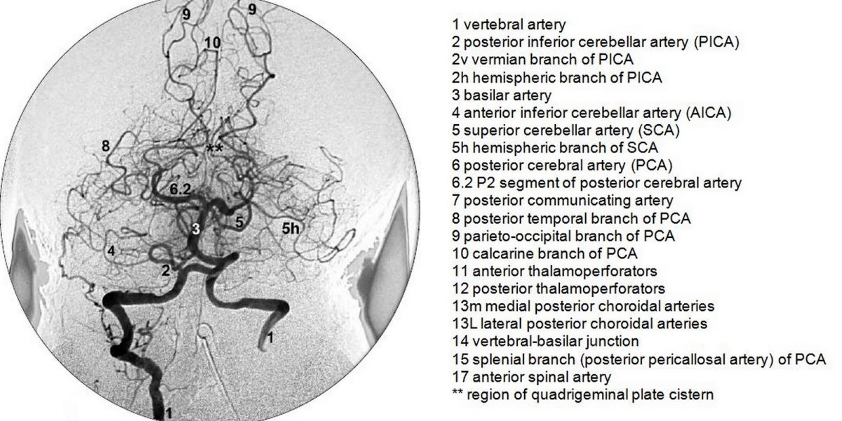 Vertebrobasilar angiography (DSA)
